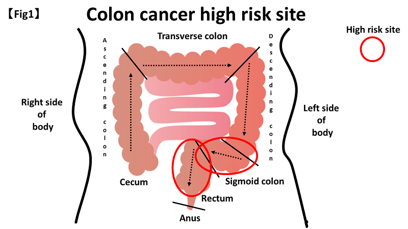 cancer colon constipation fără suplimente de detoxifiere